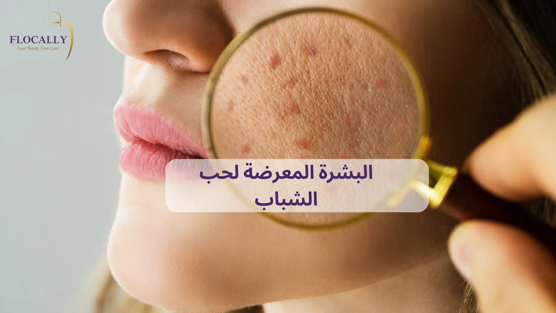 البشرة المعرضة لحب الشباب